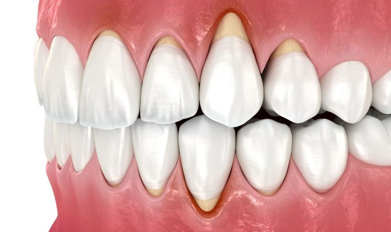 A close up of a person 's teeth and gums on a white background.