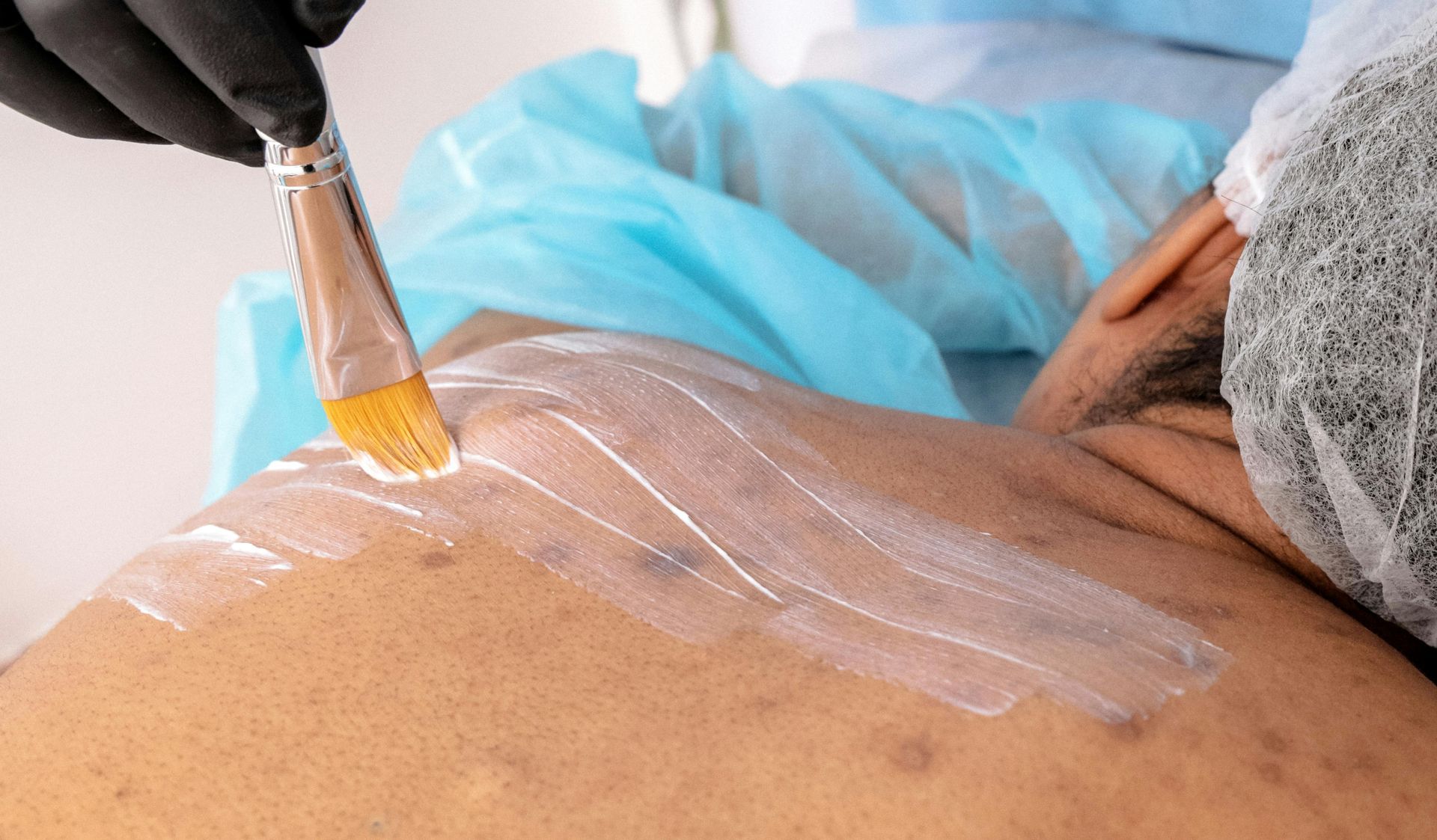 Una mano enguantada utiliza un pincel para aplicar un gel de tratamiento fino y transparente sobre la piel de la espalda de una persona.