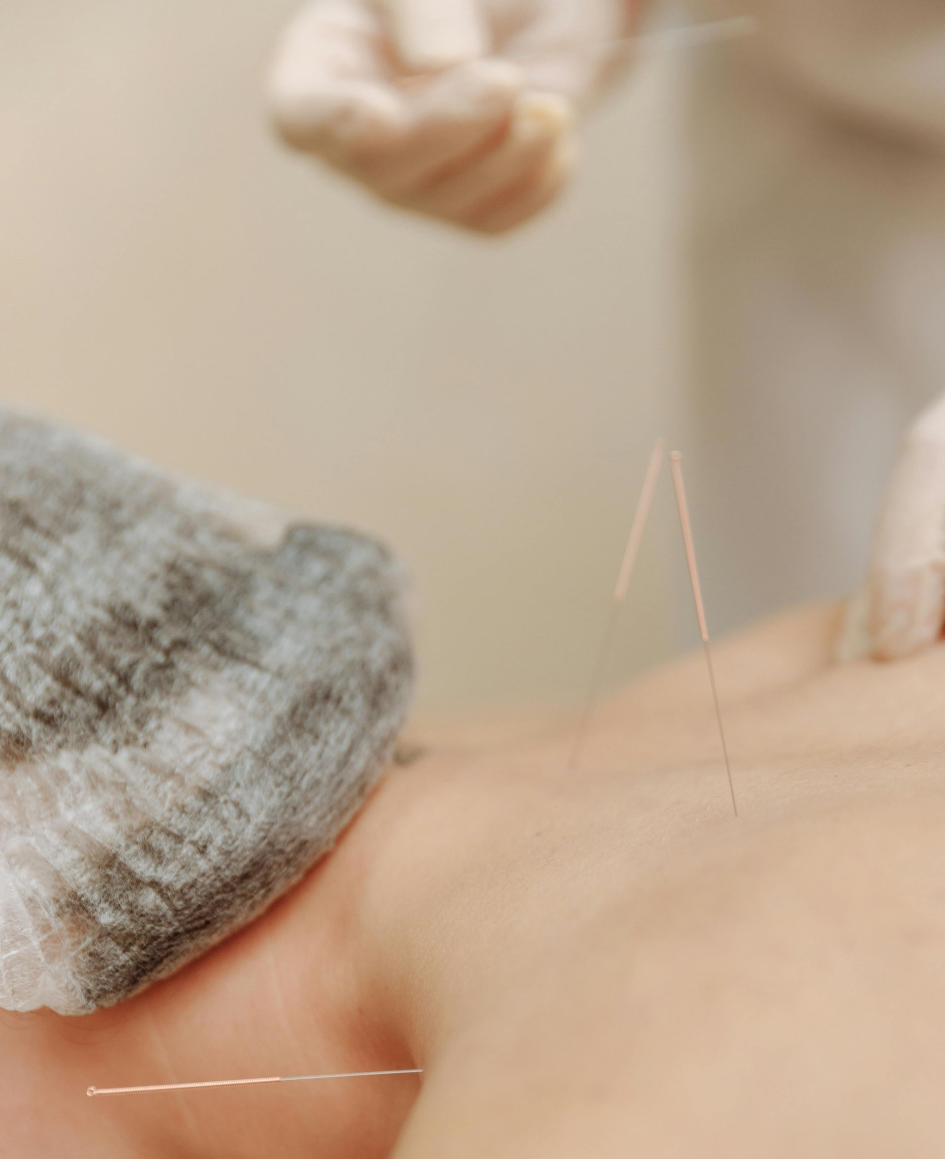 Akupunkturnadeln werden am Nacken einer Patientin gesetzt