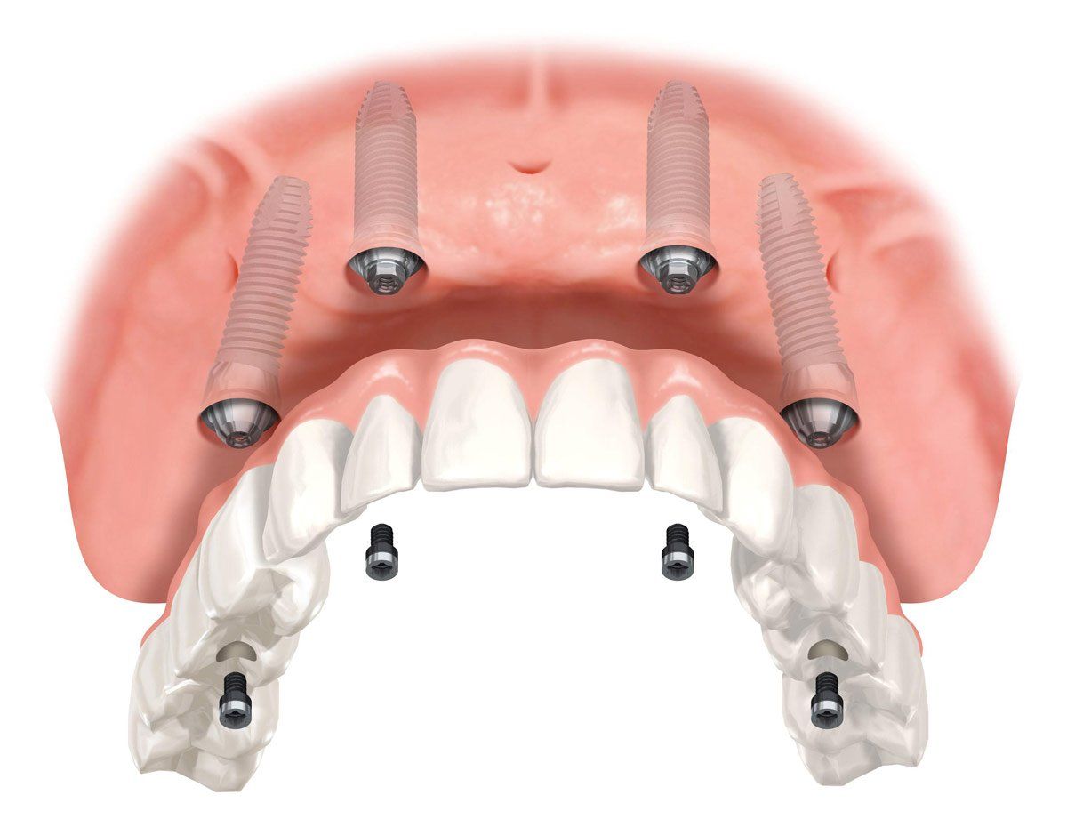 Example of all on 4 implants in Scarborough