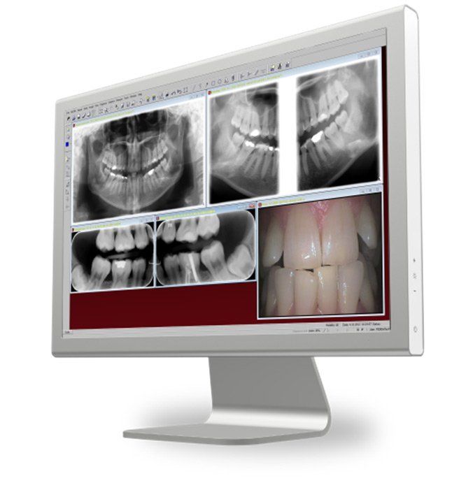 digital xray sorodex digora