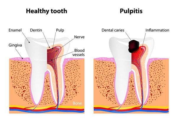 healthy tooth vs pulpitis