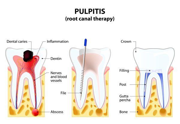 pulpitis root canal therapy
