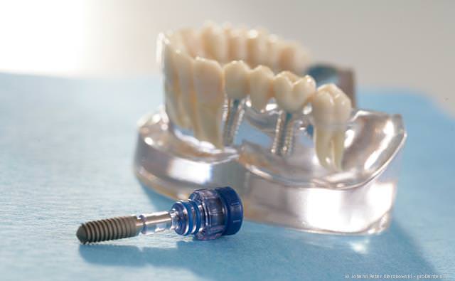 Implantate ersetzen fehlende Zähne