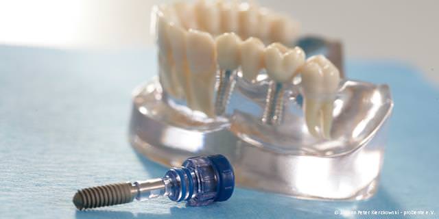 Zahnimplantate von renommierten Herstellern