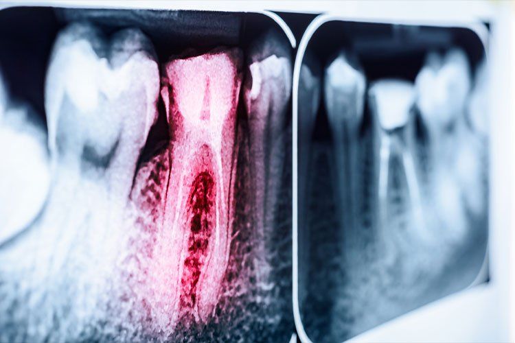Teeth X-Ray and impacted tooth