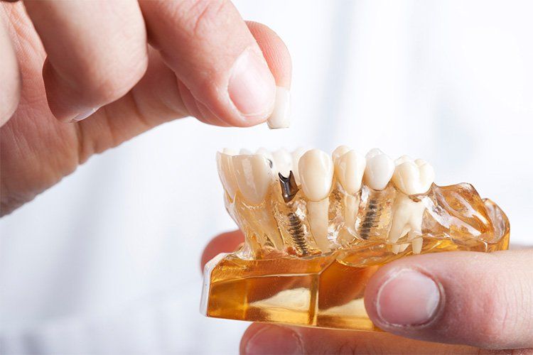Dentist holding dental implant model