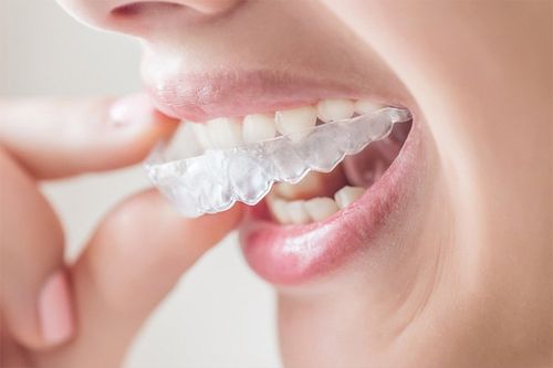 Invisalign braces being inserted to mouth