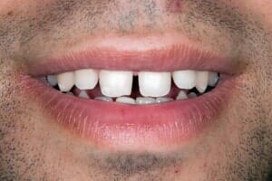 Teeth With Gap Each Other — Sarasota, FL — Sterling Dental