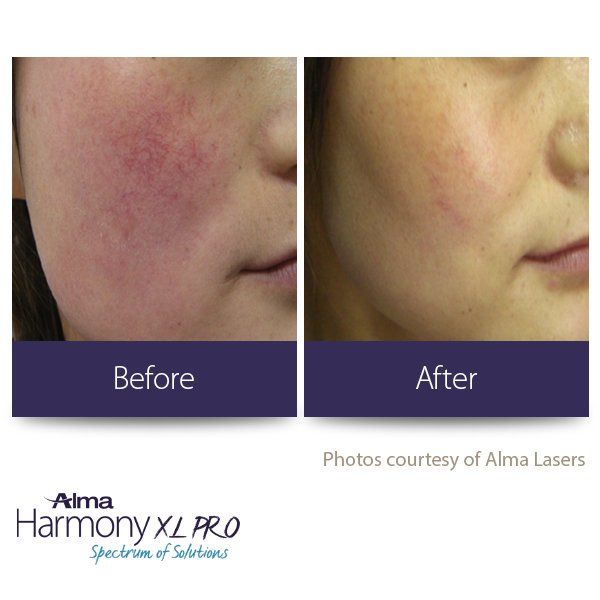 A woman 's face before and after alma harmony xl pro treatment
