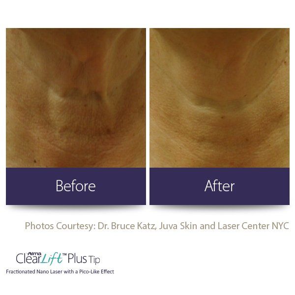 A before and after photo of a person 's neck