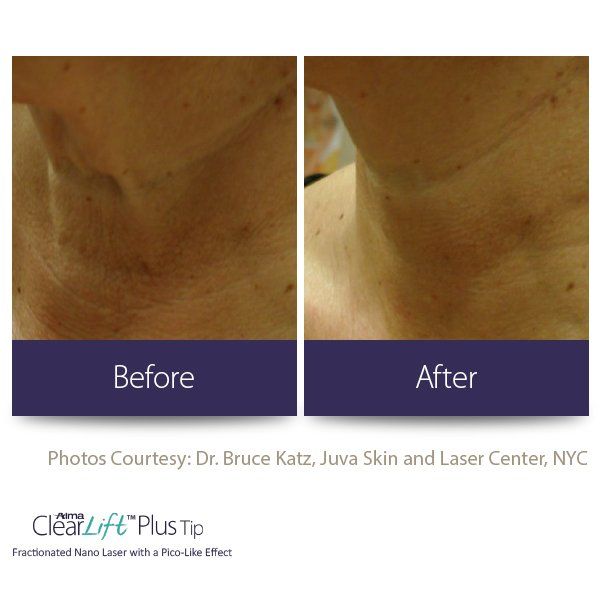 A before and after photo of a person 's neck