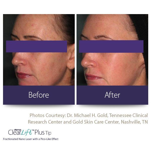 A before and after photo of a woman 's face
