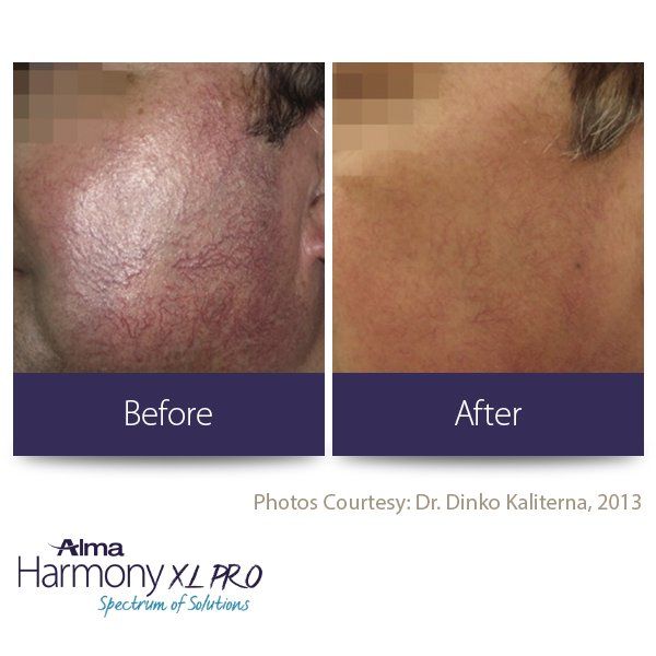 A before and after photo of a person 's face