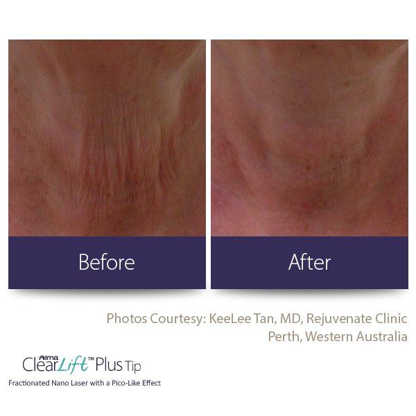 A before and after photo of a person 's neck