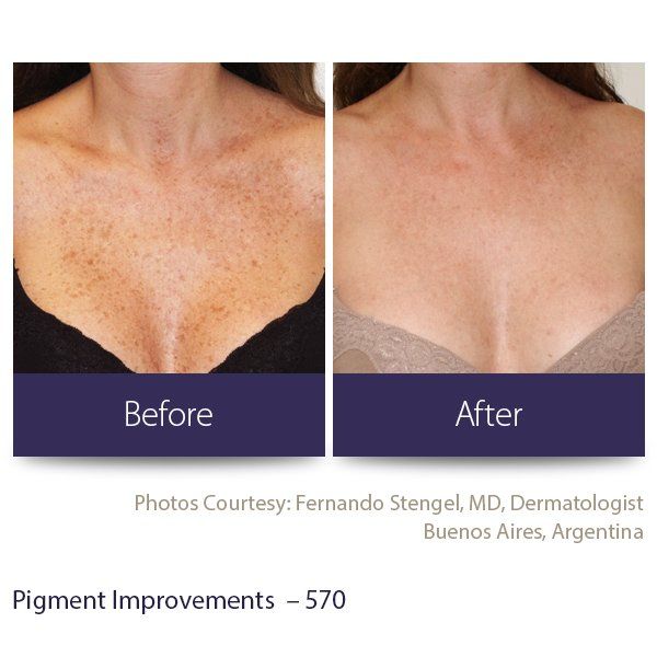 A before and after photo of a woman 's chest
