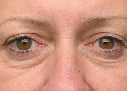 EMFACE EYES TREATMENT