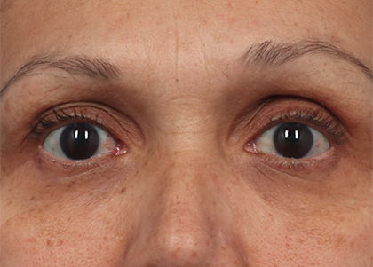 EMFACE EYES TREATMENT
