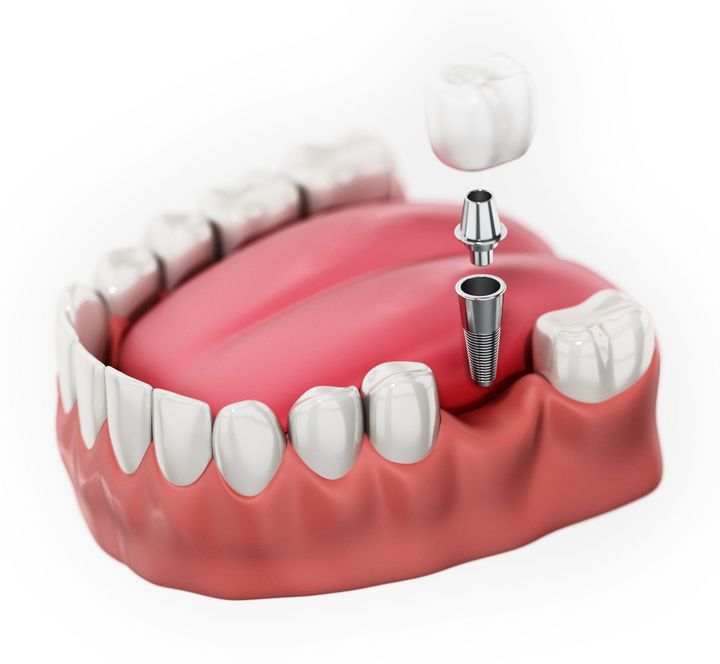 A model of a dental implant being installed in a mouth.