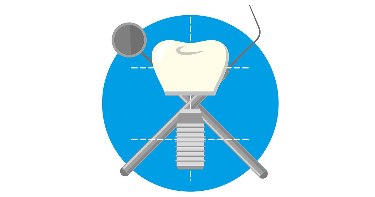 Dental Implants vs Dentures