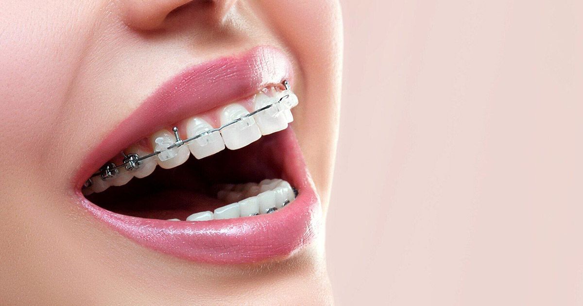 orthodontic treatment for adults