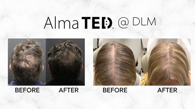 TED Hair Restoration | Needle‑Free Hair Growth
