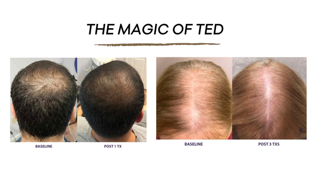 TED Hair Restoration | Needle‑Free Hair Growth