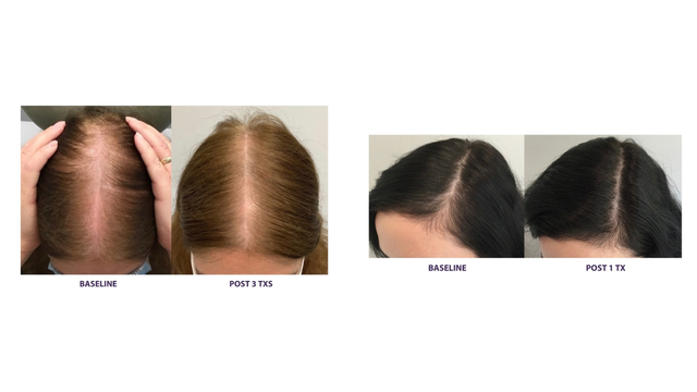 TED Hair Restoration | Needle‑Free Hair Growth