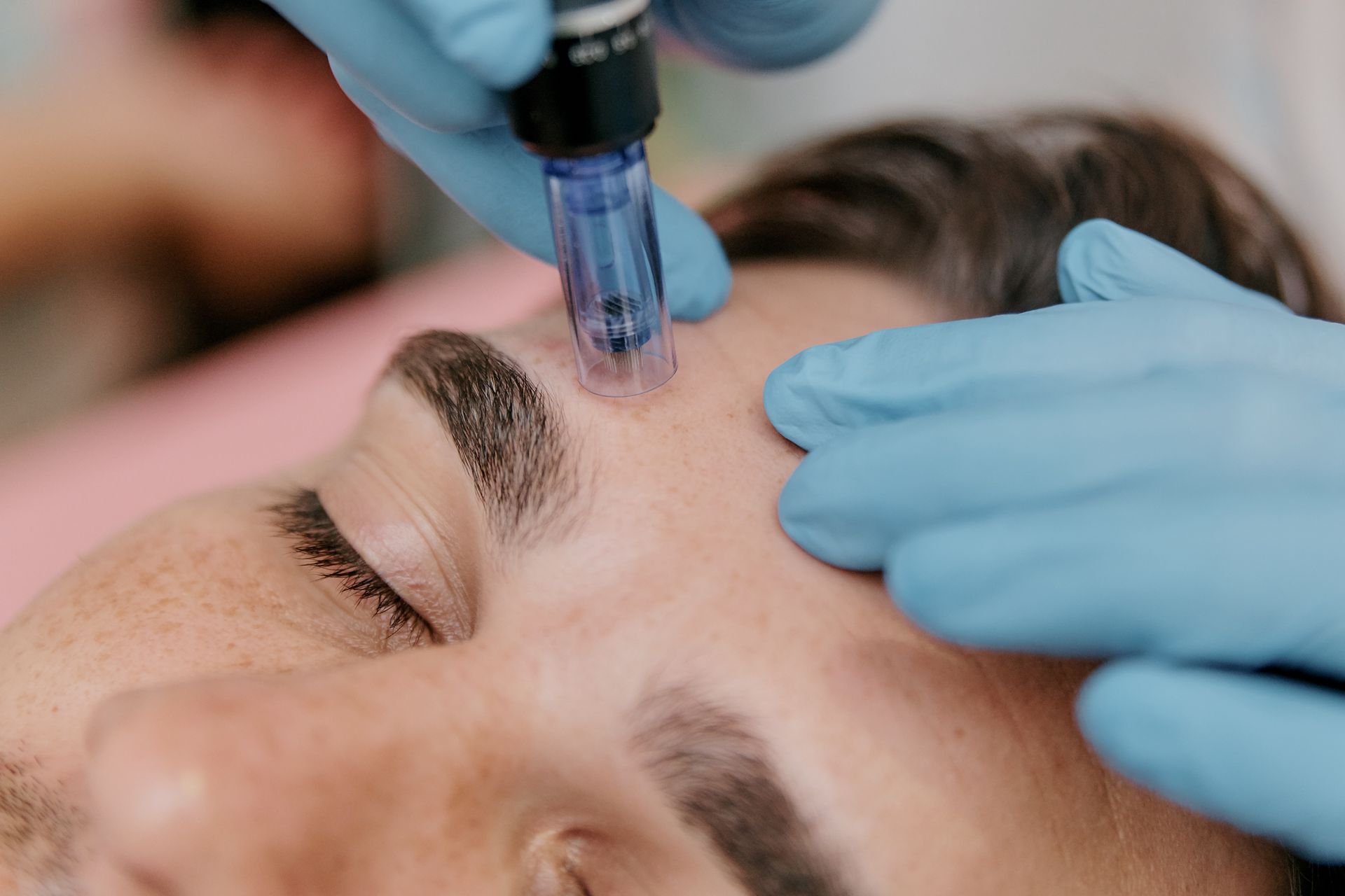 A man is getting a microneedle treatment on his face.