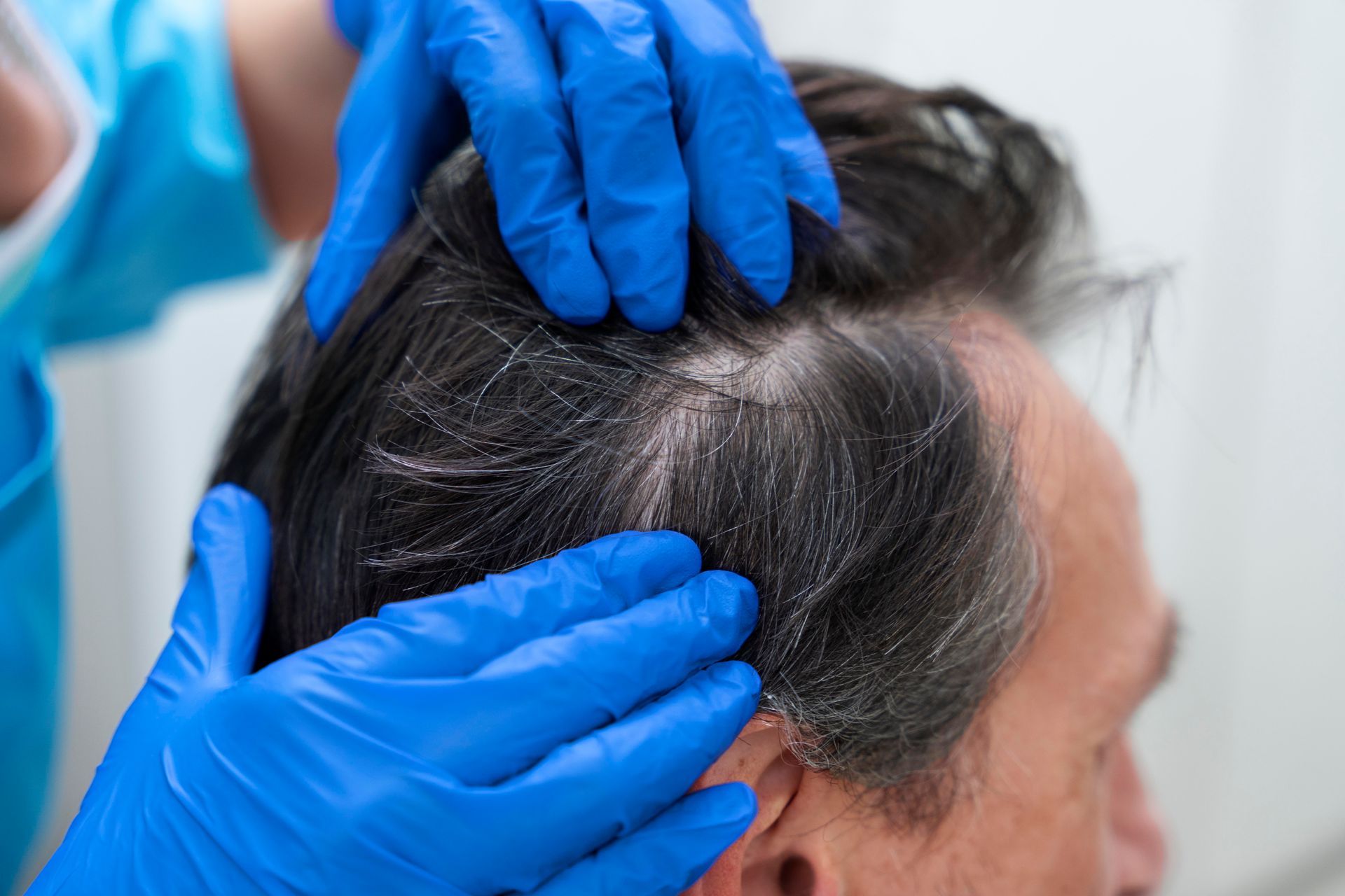 A doctor is examining a man 's hair with blue gloves.