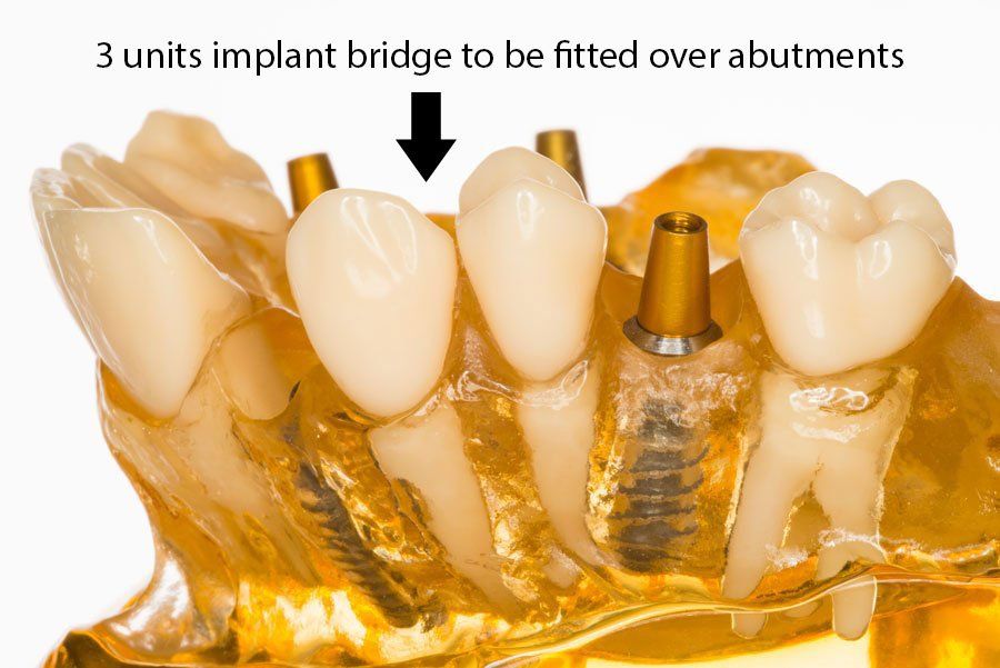 restored with 2 more unit implant crowns