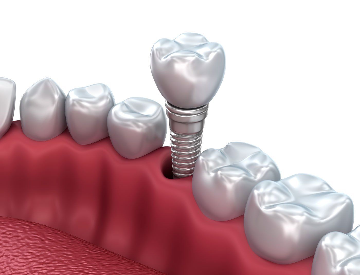 dental implants