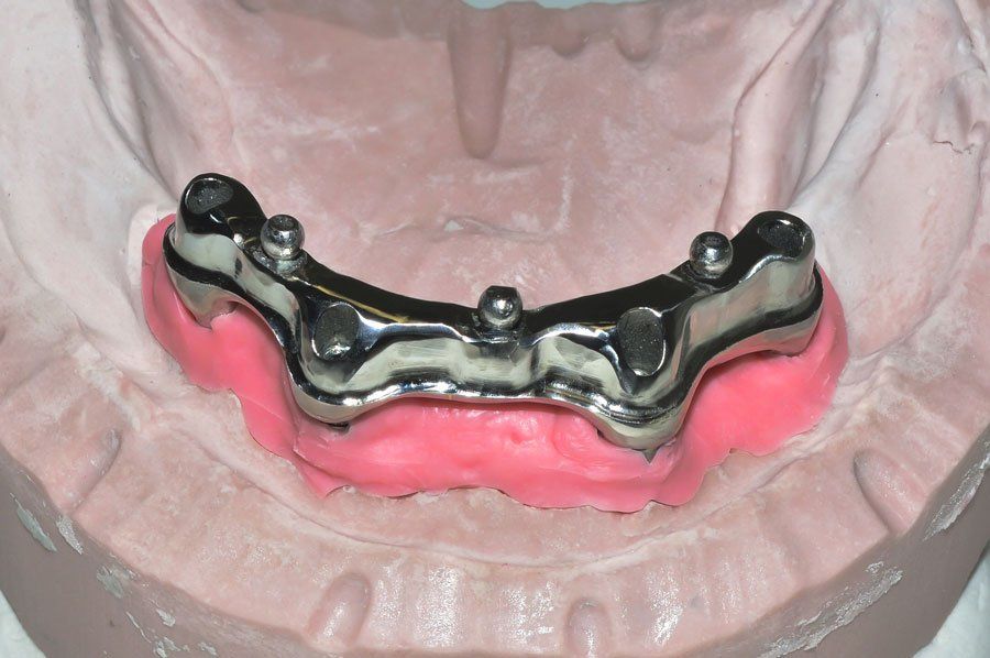 lower implant framework