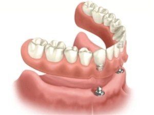 full upper overdenture supported by 2 units implants