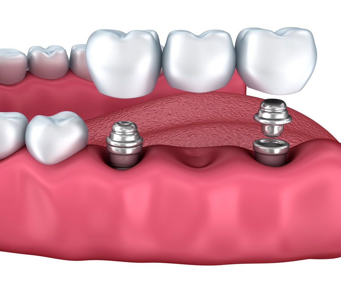 3 unit implants supported bridge using 2 unit implants