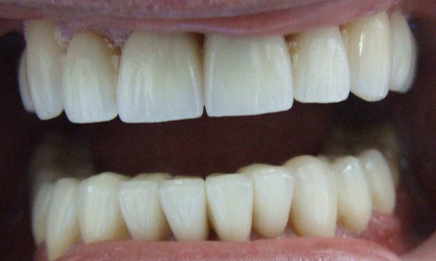 severely worn teeth after treatment