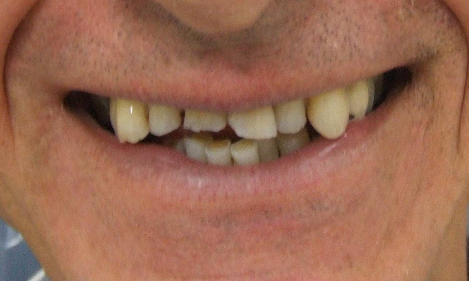 before porcelain veneer