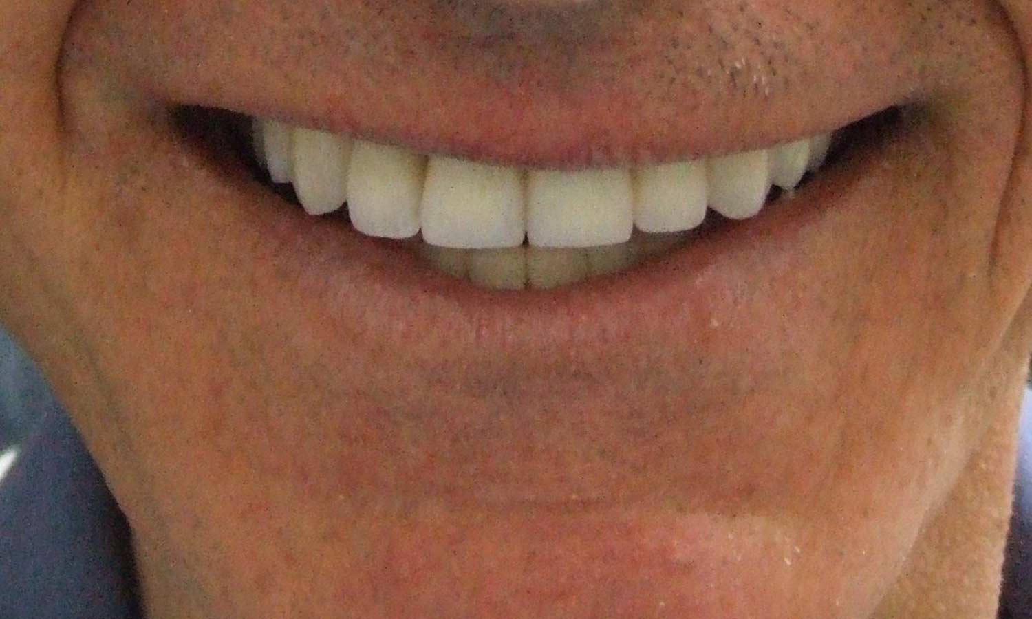 after porcelain veneer