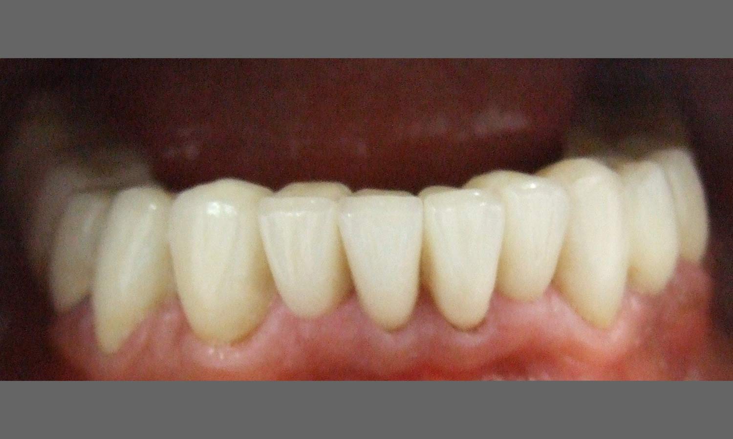 porcelain veneer after image