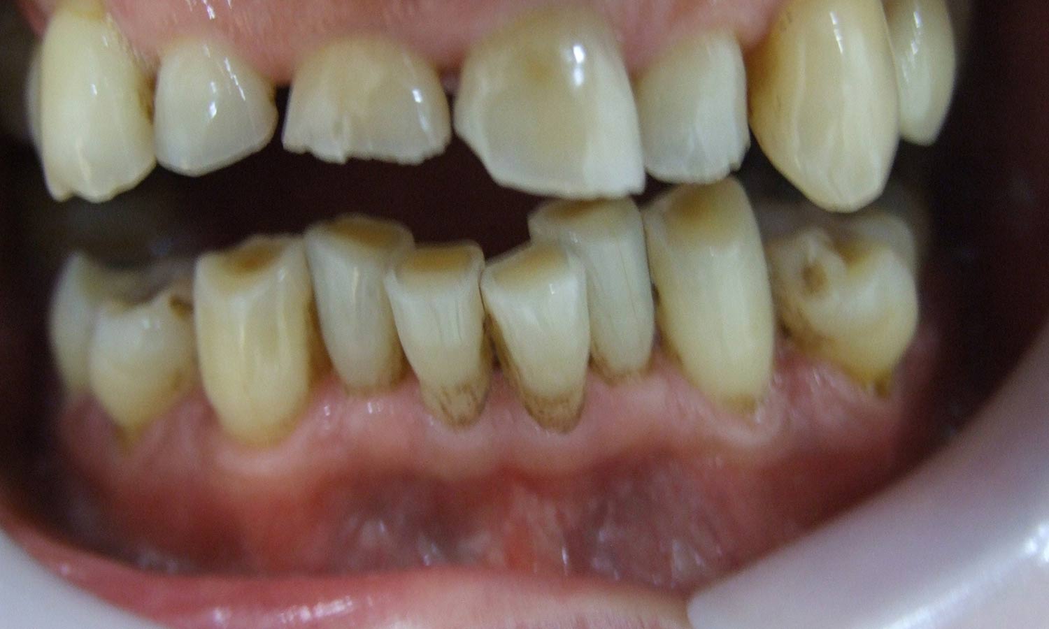 severely worn teeth before treatment