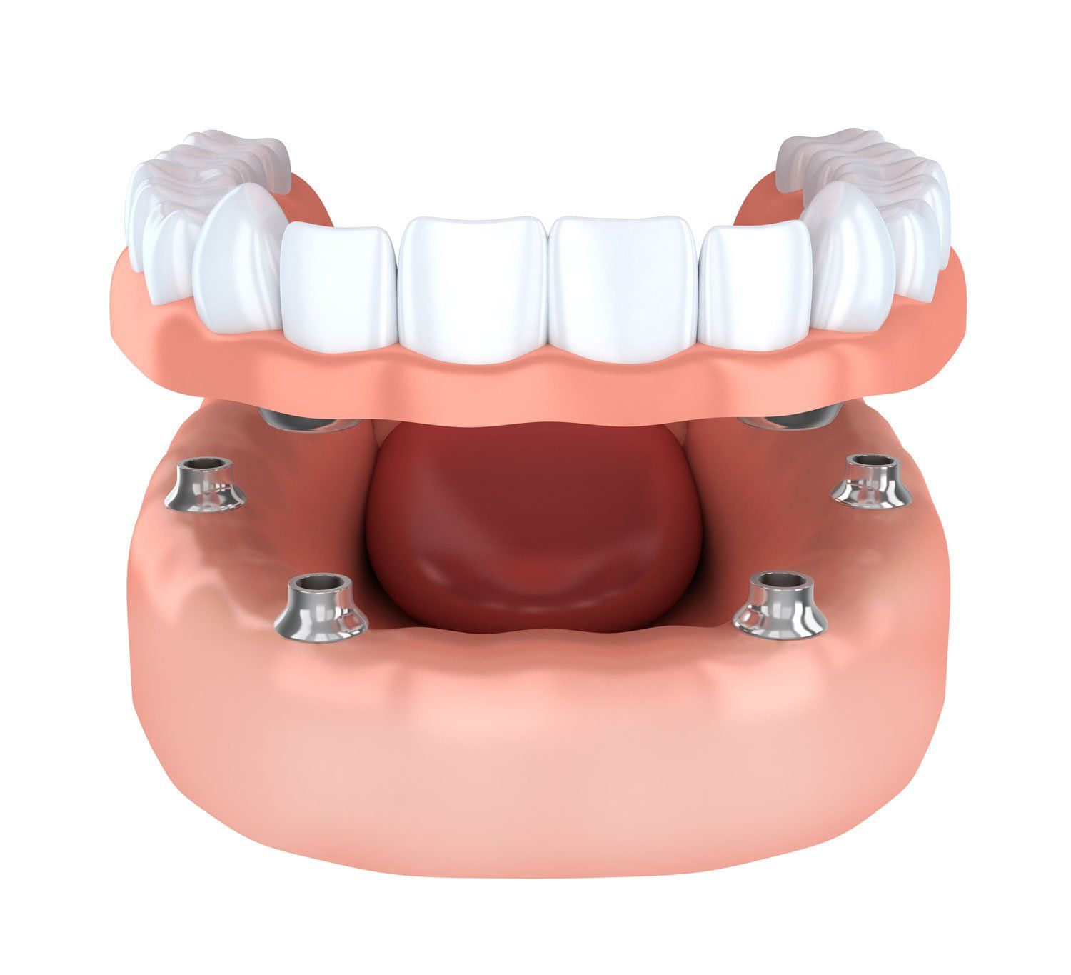 full upper overdenture supported by 4 units implants