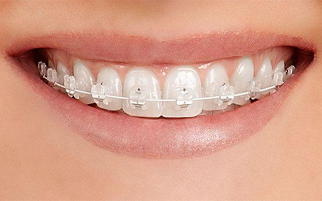 DR. MARCO TULIO CÁRDENAS - Bracket zafiro