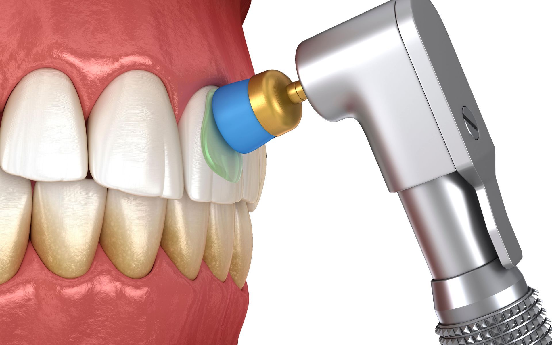 Digital illustration of a dental cleaning.