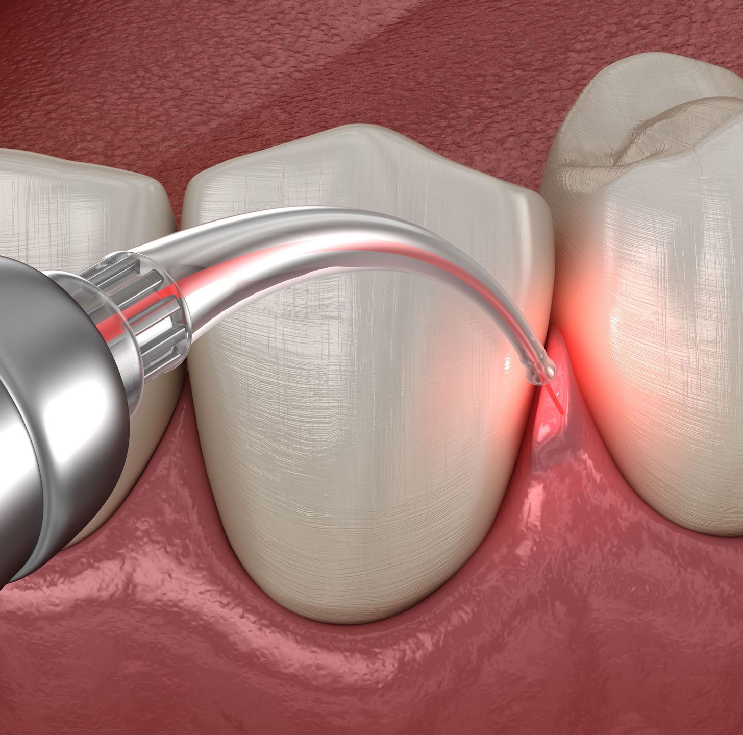 Digital illustration of laser dentistry.