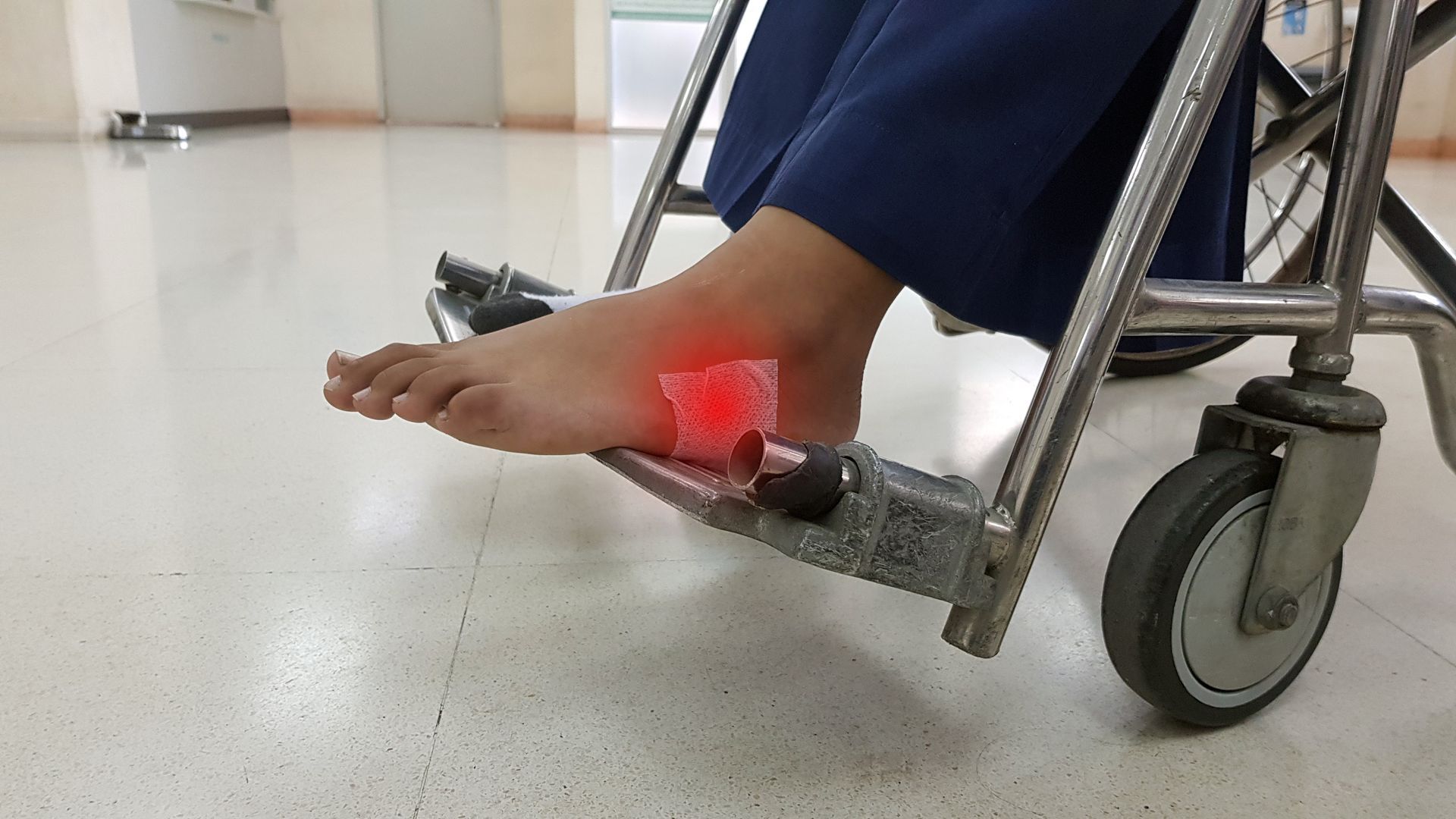 Bare foot with bandaged wound rests on wheelchair footrest, inside a building.