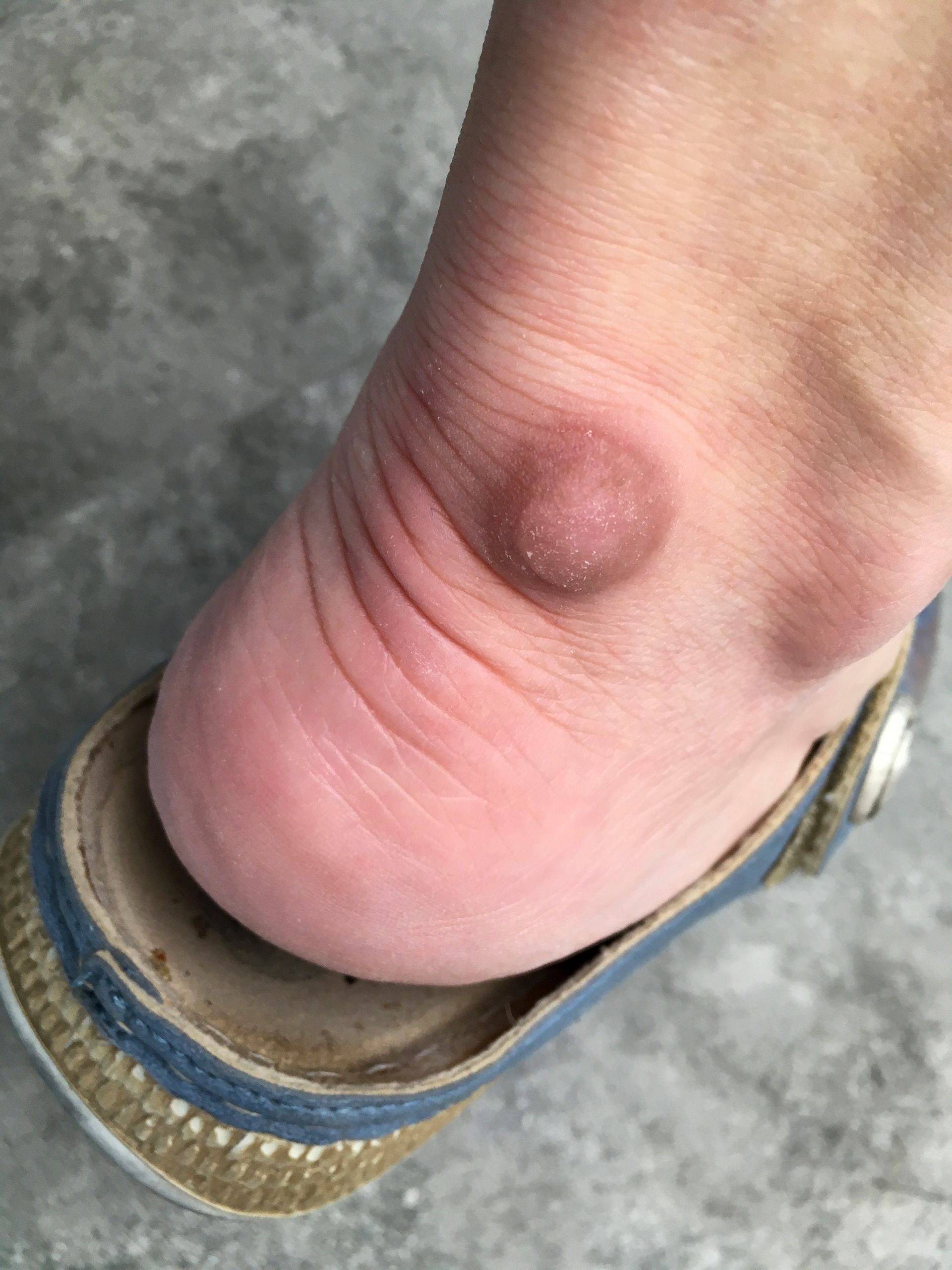 A person's foot with a large, raised bump on the heel, wearing a shoe.