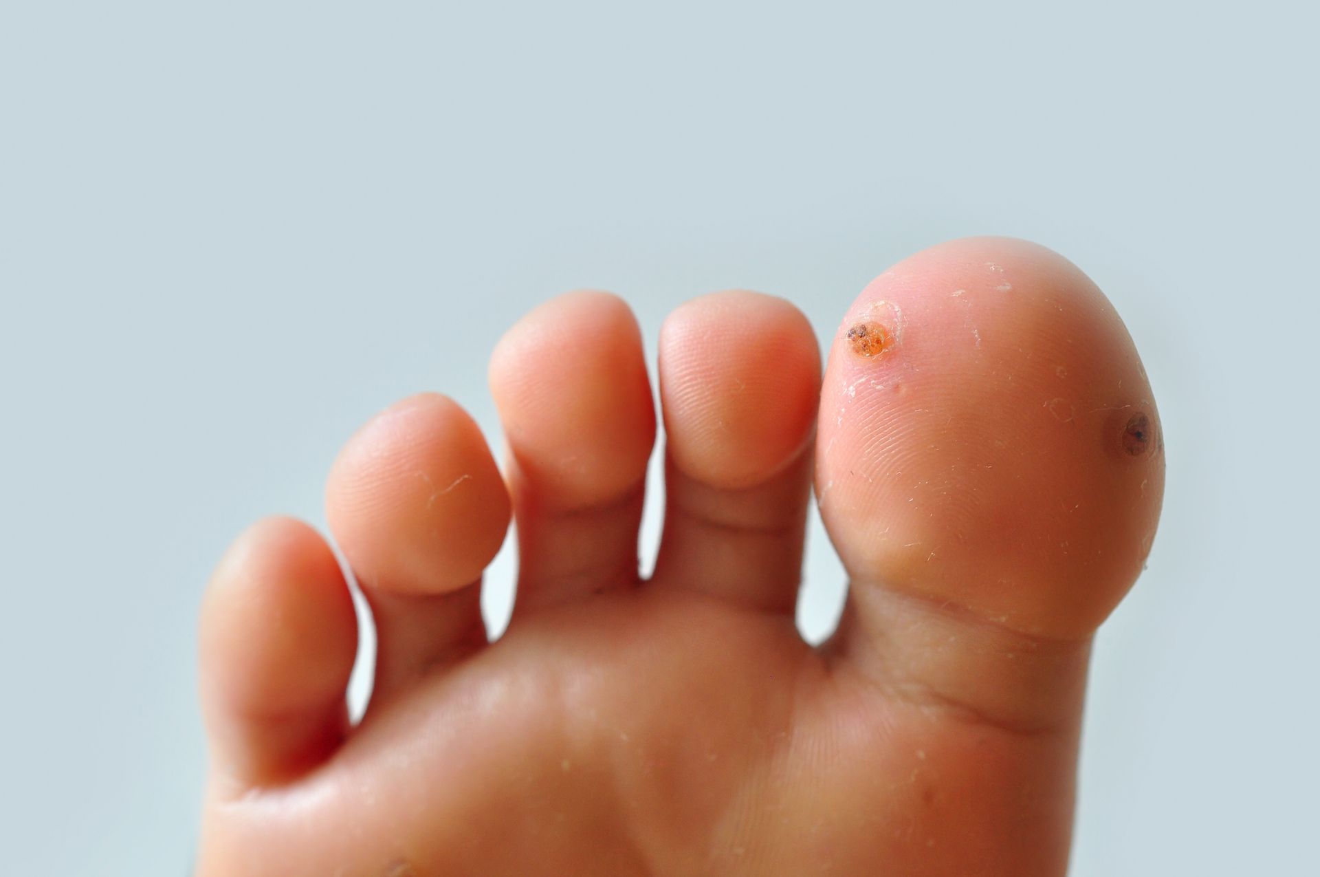 Foot with a wart on the big toe, on a light background.