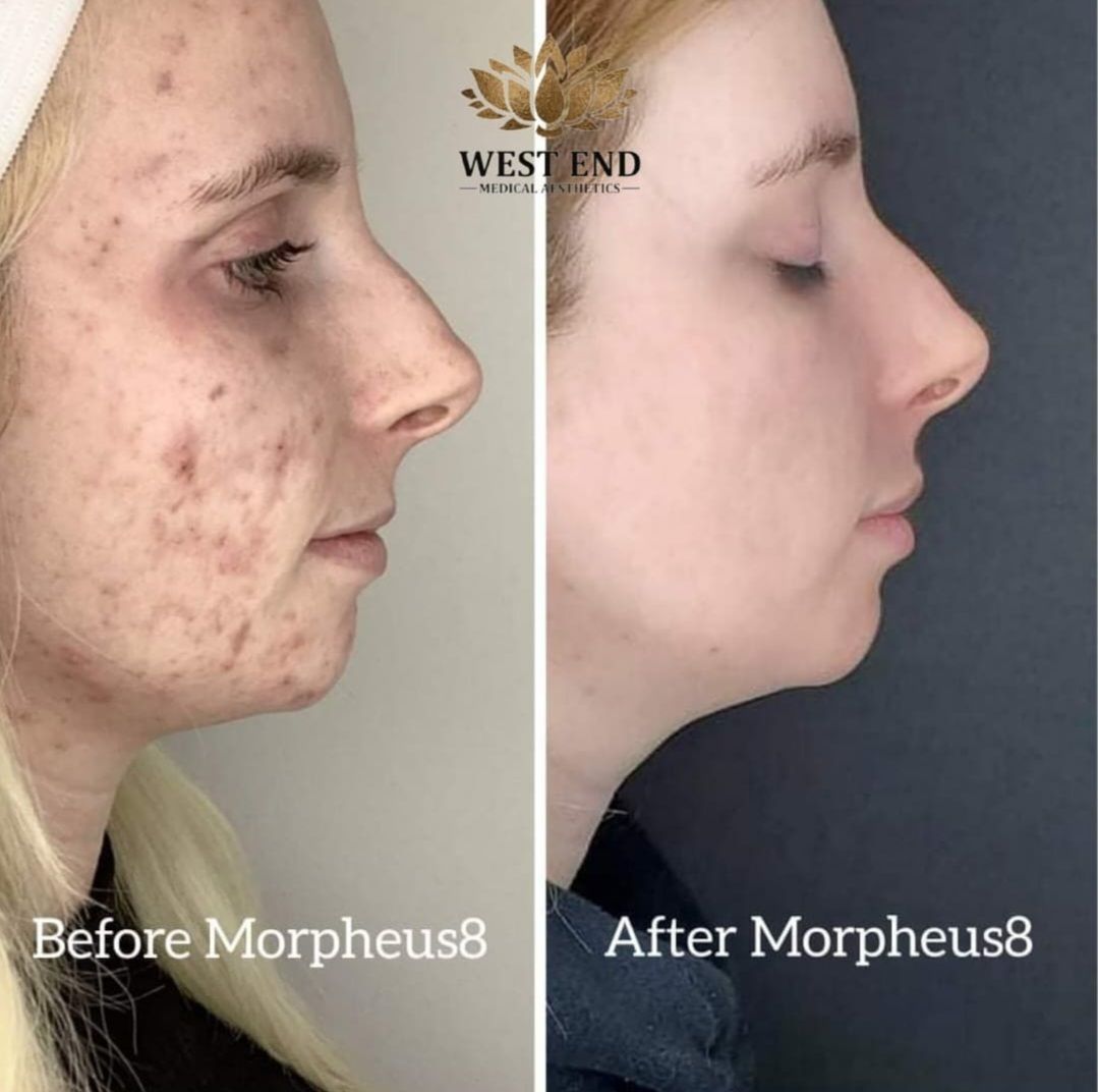 a before and after photo of a woman 's face