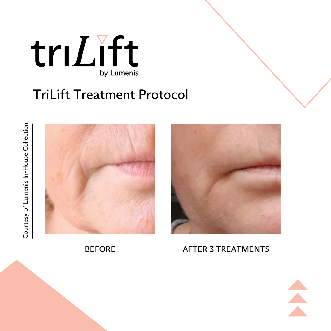 a woman's face before and after TriLift treatment