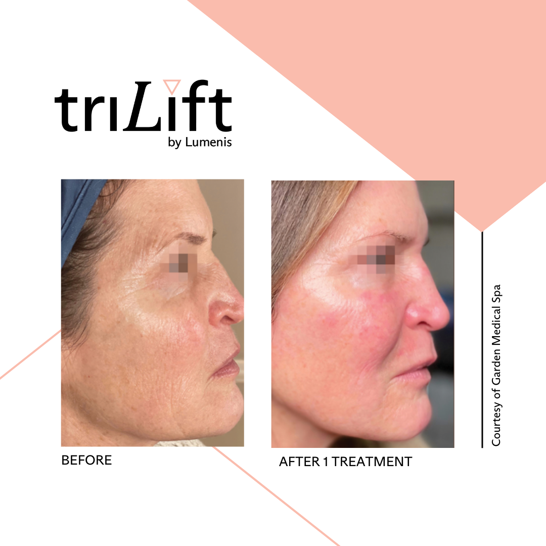 a woman's face before and after TriLift treatment